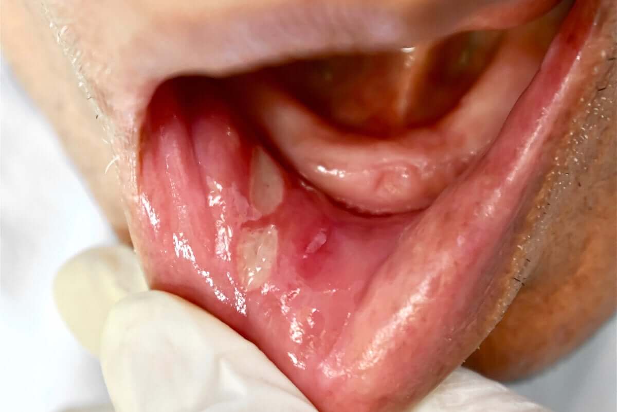 sores on tongue from smoking crack